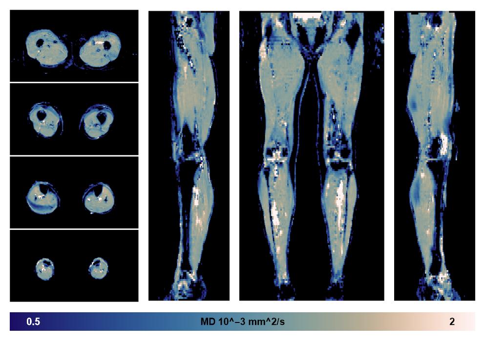 IVIM corrected whole leg muscle mean diffusivity obtained from diffusion tensor imaging.